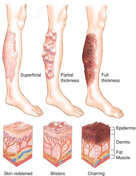 <ul><li><p><strong>Superficial</strong></p><ul><li><p>Skin reddened</p></li></ul></li><li><p><strong>Partial thickness</strong></p><ul><li><p>Blisters</p></li></ul></li><li><p><strong>Full thickness</strong></p><ul><li><p>Charring</p></li></ul></li></ul><p></p>