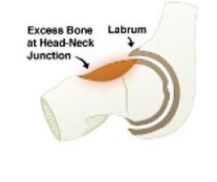 <p>What type of FAI is characterized by extra bone growth of femoral head/neck that results in non-rounded shape (too broad) causing shearing at the chrondro-labral junction - young athletic males</p>