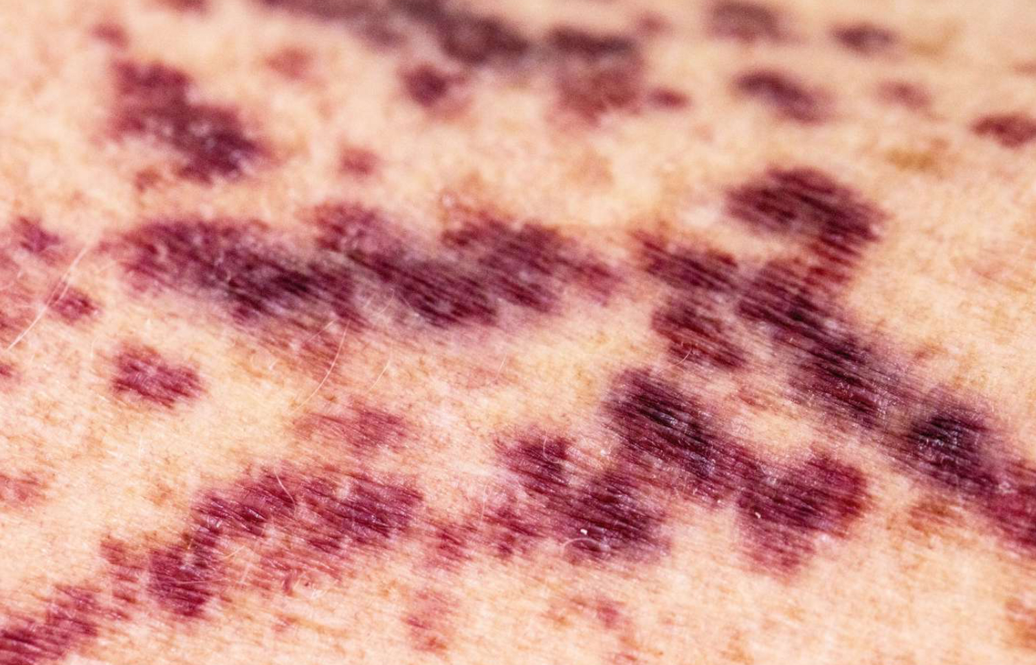 <p>Purpura</p>