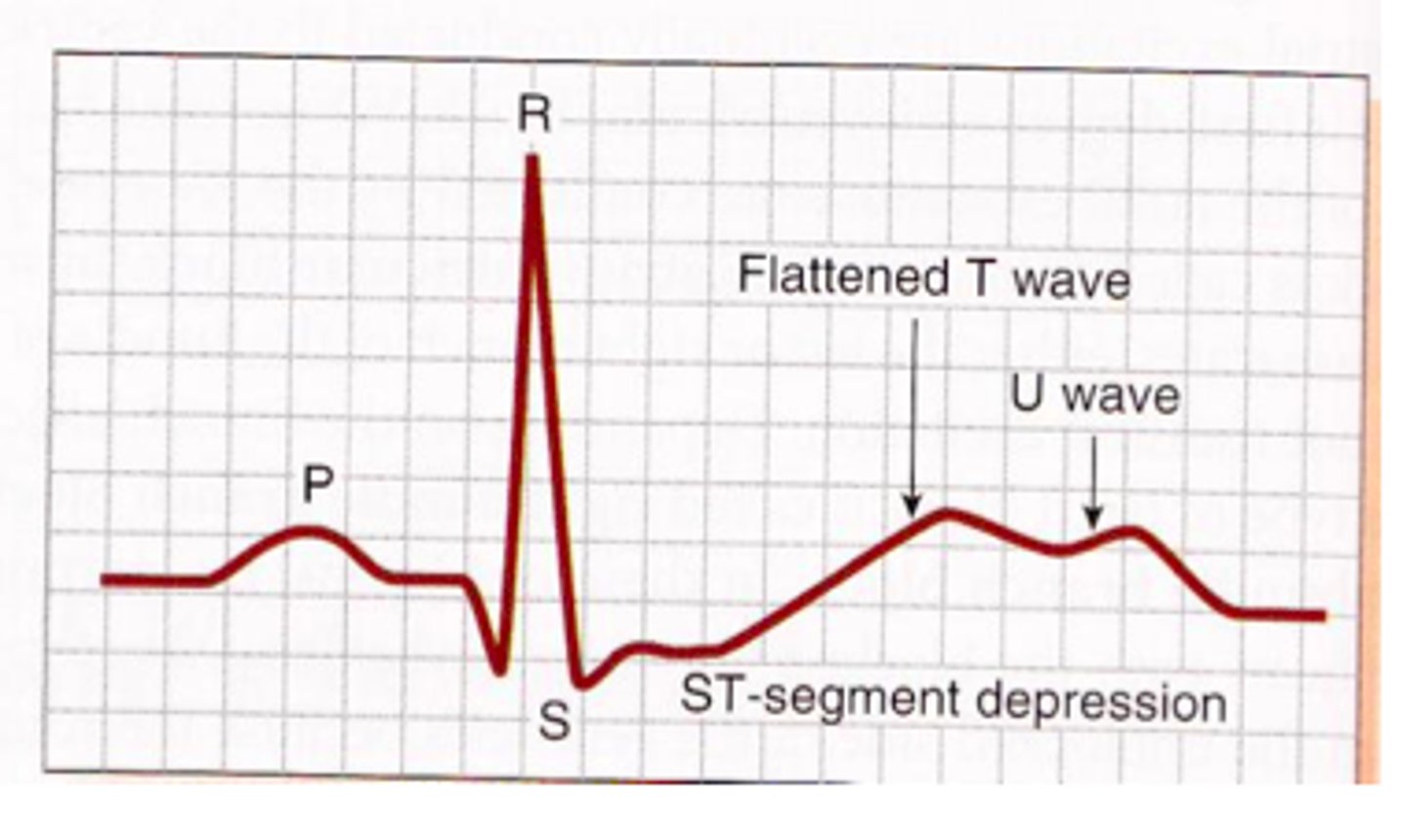 <p>levels controlled by aldosterone; imbalances of this ion are easily seen on an ECG (echocardiogram)</p>