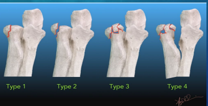 <p><strong>Radial Head/Neck Fracture: Treatment</strong></p><p>-Ice, _________</p><p>-Non-displaced → ____ vs posterior long arm ______ at 90 degrees (depending on severity)</p><p>-Refer to _____ for complex or __________ fractures → pt may need ORIF</p>