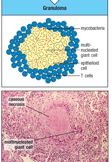 <p>Pathogens incompletely killed by a TH1 response in macrophage</p><p>Gives rise to a chronic, low level infection that requires an ongoing TH1 response to limit the spread of pathogen</p><p>Granuloma is formed=microbes are held in a macro surrounded by activated lymphocytes</p><p>Fuse of macro leads to multinucleated giant cells</p>