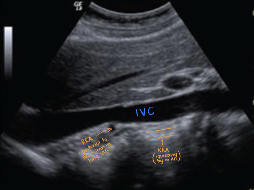 <p>RRA is <u>longer</u> than LRA and courses <u>posterior to IVC</u> (goes <em>excuse me </em>under the IVC)</p><p></p>