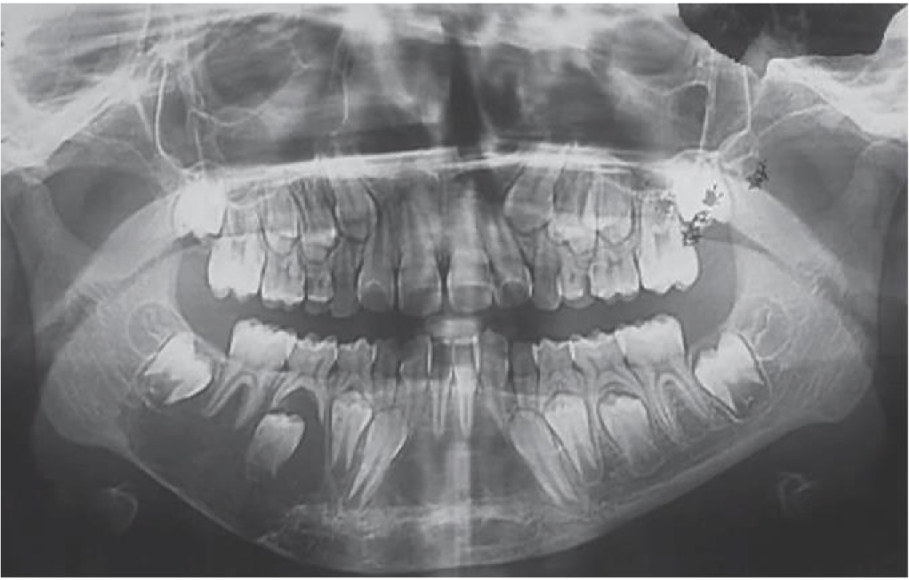 <p>A 9 year old boy presented with swelling of the lower face. Provide DD</p>