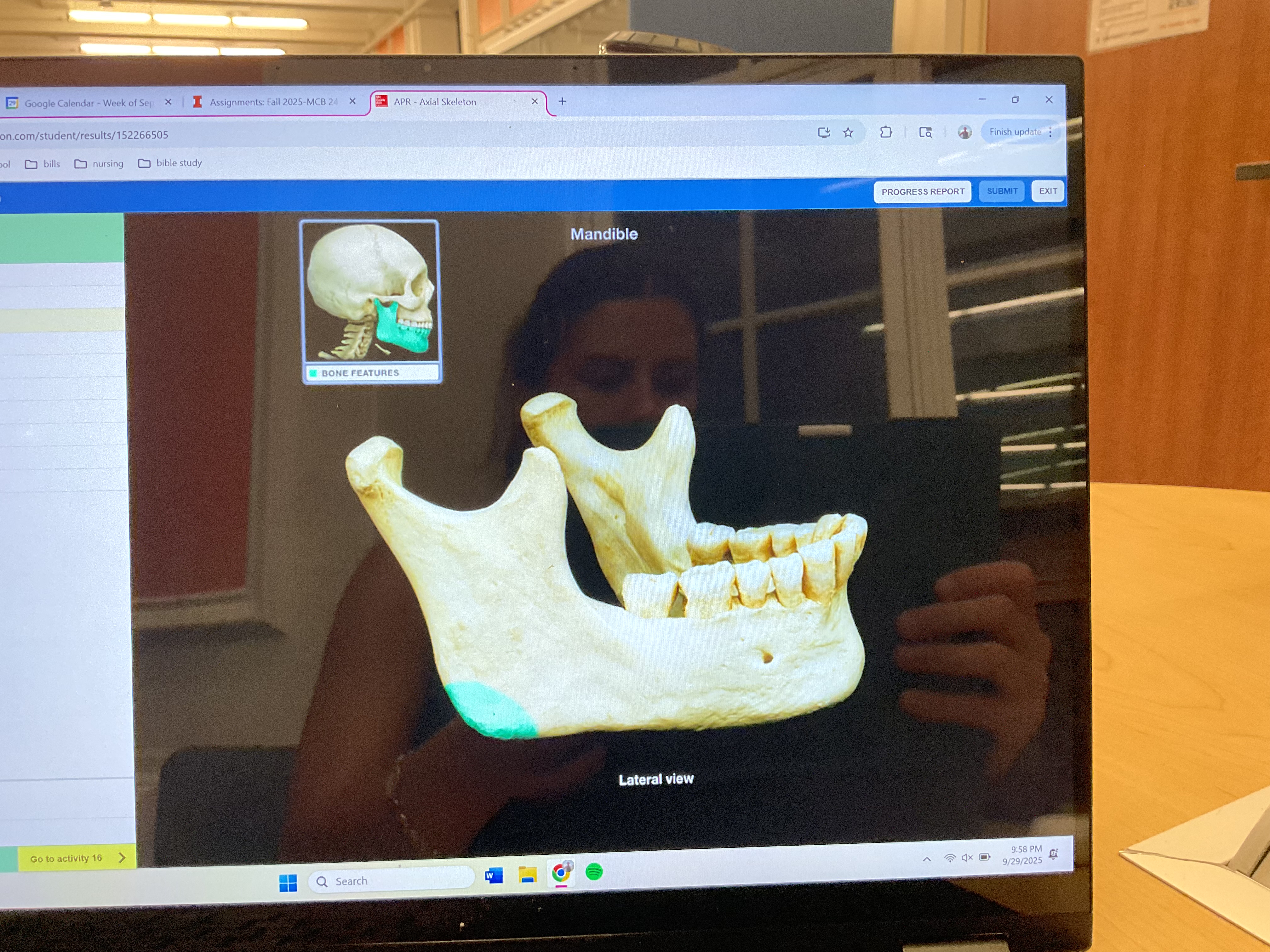 <p>Angle of mandible </p>