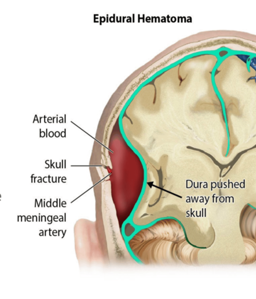 <p>• Focal injuries often caused by a linear and direct impact force (e.g., hit with baseball or bat)</p><p>• Associated with skull fractures and lacerations</p>