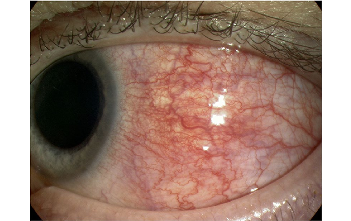 <p>Diffuse </p>
