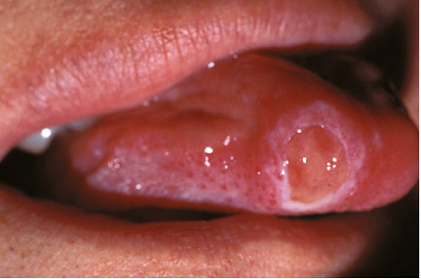 <p>Hardened, painless chancre develops 3 weeks after exposure</p>