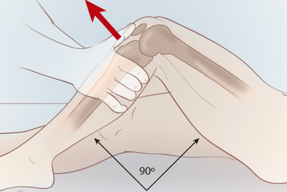 <ol><li><p>Patienten ligger på rygg med knäet böjt till ca 90°</p></li><li><p>Undersökaren sitter på patientens fot för att stabilisera den</p></li><li><p>Placera båda händerna runt tibia, precis under knäet med tummarna på tuberositas tibiae</p></li><li><p>Dra tibia framåt i en snabb men kontrollerad rörelse</p></li><li><p>Notera rörelseomfång och end-feel </p></li><li><p>Jämför tibias rörelse ned det andra knäet</p></li></ol><p><strong>Vid ökad förskjutning ventralt misstänks ruptur av främre korsbandet</strong></p>