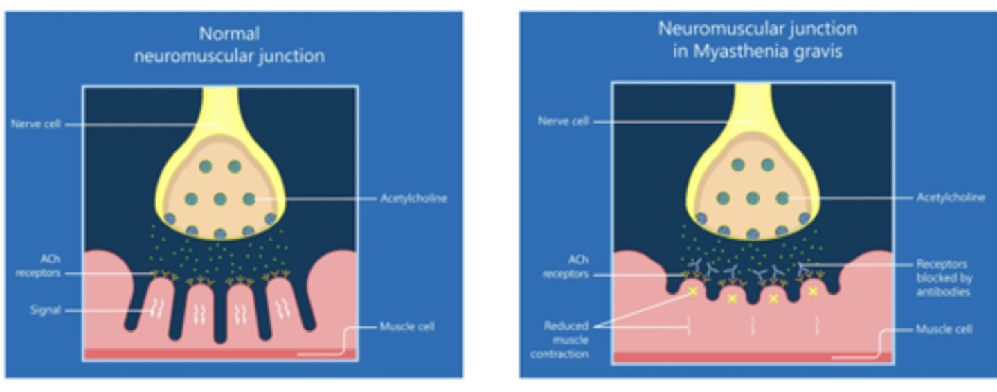 <p>- Type II</p><p>- Antibodies against acetylcholine receptors in neuromuscular junction (NMJ)</p>