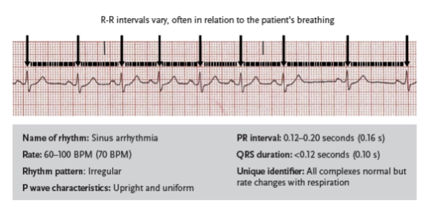 <p>a sinus rhythm in which all characteristics are normal except for rhythm regularity; R-R intervals are irregular and usually vary with the patient’s breathing</p><ul><li><p>Occurs naturally in some children and adults</p></li><li><p>Rarely requires treatment</p></li><li><p>If the heart rate slows so dramatically that it causes problems with circulation or cardiac output a medication may be prescribed</p></li></ul><p></p>