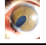 <p>iris prolapses </p>