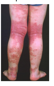 <p>what type of eczema is this?</p>