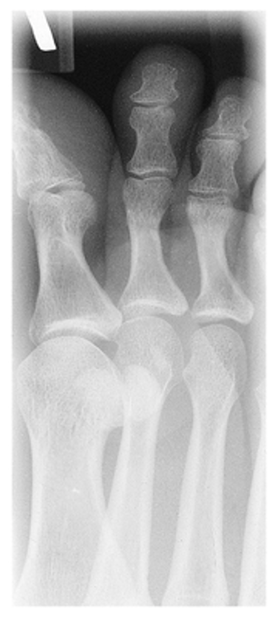 <p>- Digits and minimum of distal ½ of metatarsal demonstrated</p><p>- IP and MTP joints appear open</p><p>- Increased concavity on one side of shaft</p><p>- Heads of metatarsals not overlapped</p><p>- Optimal exposure factors</p>