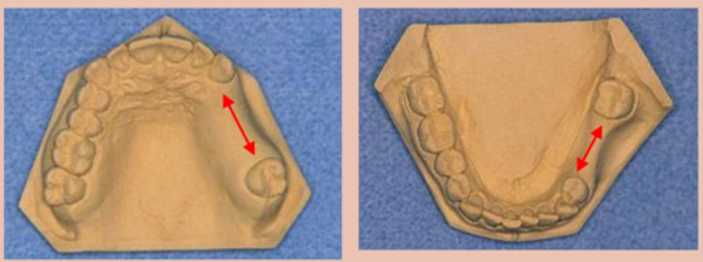 <p>Tooth supported:</p><p>A unilateral edentulous area with natural teeth both anterior and posterior to the area</p>