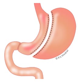<p>Which type of gastric bypass is shown?</p>