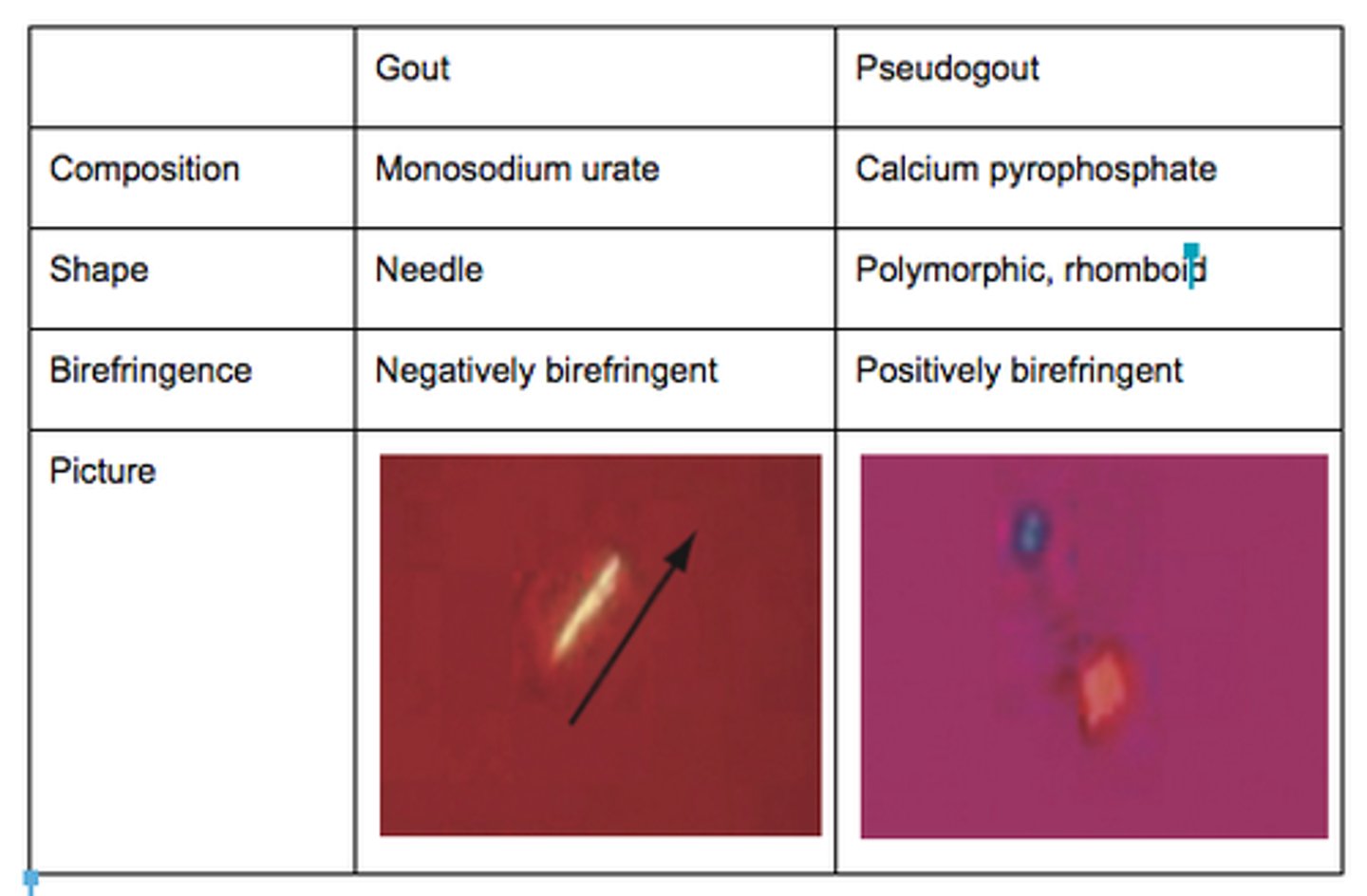 <p>Pseudogout: deposit of calcium pyrophosphate crystals</p>