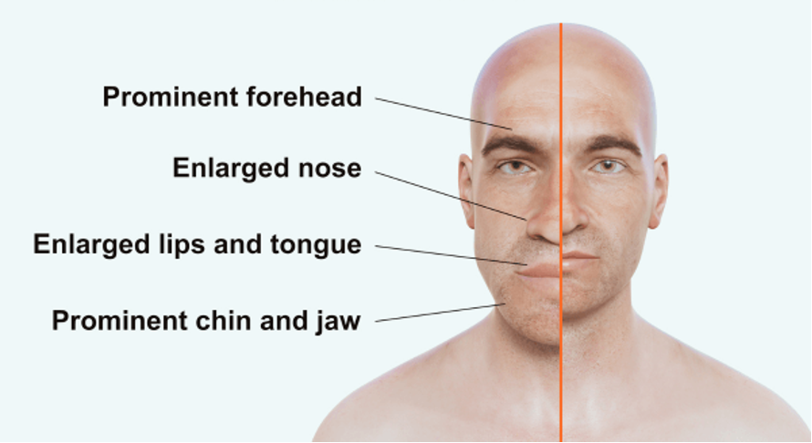 <p>What does this refer to</p><ul><li><p>Diaphoresis</p></li><li><p>Deep voice/slow speech</p></li><li><p>HTN</p></li><li><p>Mitral valve regurgitation</p></li><li><p>Enlarged head with frontal bossing + deepened facial folds</p></li><li><p>Enlarged jaw with increased teeth spacing</p></li><li><p>Enlarged fingers and feet</p></li><li><p>Skin tags</p></li><li><p>Skin feels <strong><mark data-color="#f9ff62" style="background-color: rgb(249, 255, 98); color: inherit;">“doughy”</mark></strong></p></li><li><p>Neuropathy</p></li><li><p>Muscle weakness</p></li></ul><p></p>