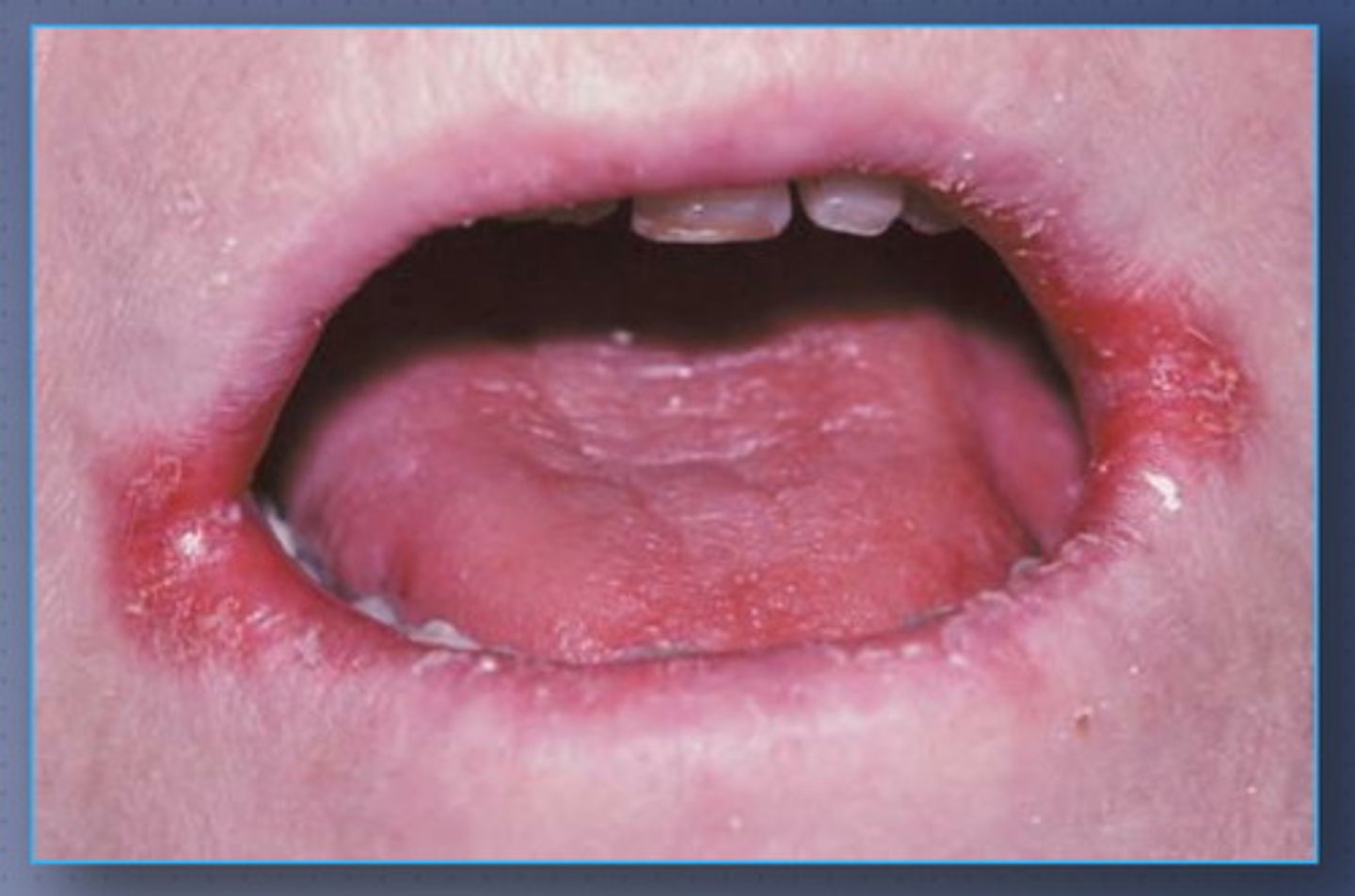 <p>describe redness and cracking at the corners of the mouth</p>