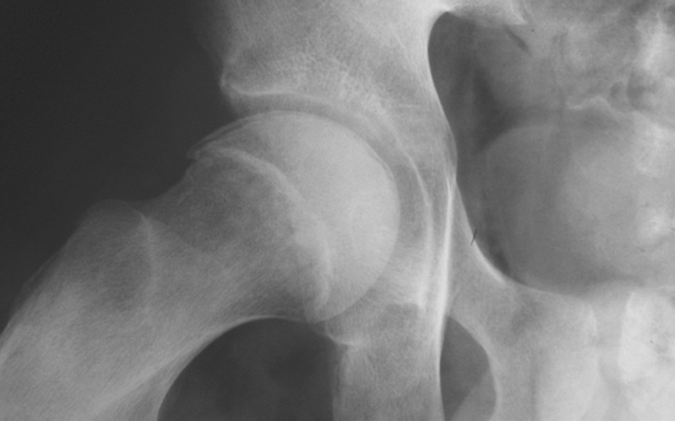 <p>A crescent-shaped lucent subchondral fissure indicating a fracture line; seen best in abducted position.</p>
