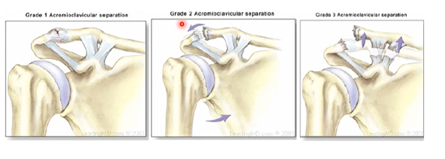 <p>the levels of tear and the number of ligaments damaged in the separation of the joint</p><p></p><p>Grade 1- partial tear of acromioclavicular ligament</p><p>Grade 2 - bones are detached from one another</p><p>Grade 3- separation of the acromioclavicular ligament and separation of the coracoclavicular ligament. </p><p></p><p>Grade 3 most severe type of separation cause we’ve completely detached the clavicle from the scapula</p>