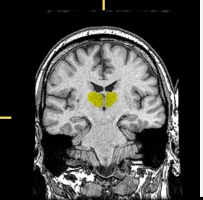 <p>What part of the brain is highlighted?</p>