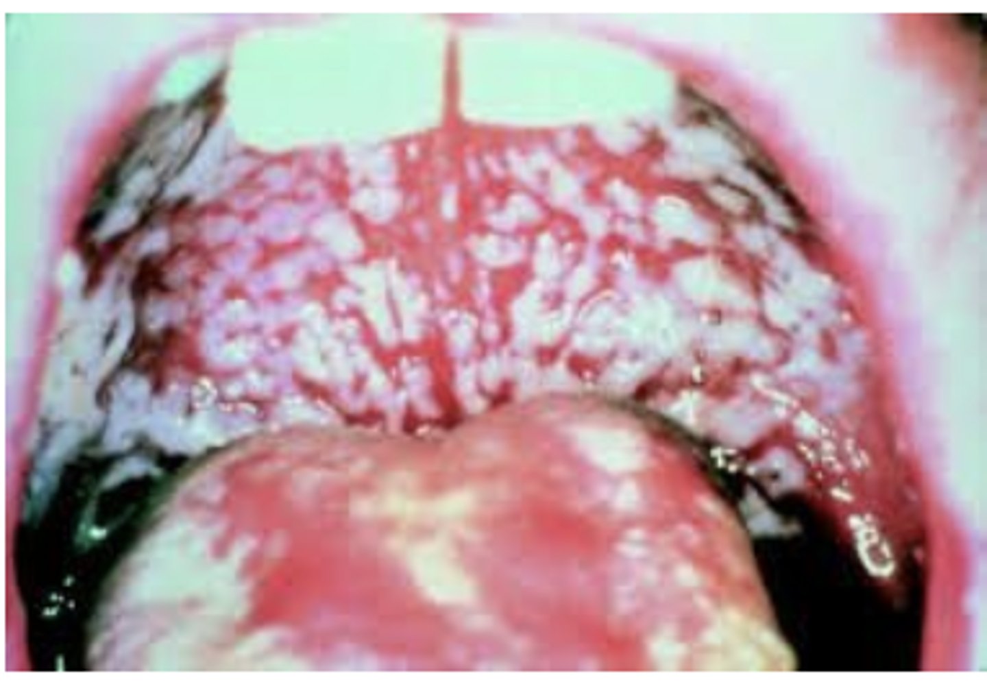 <p>Patient has a wipeable white lesion. What's the ddx?What's the ideal treatment? (pic of pseudomembranous candidiasis aka Thrush)</p>