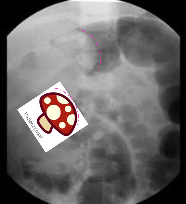 <p>What causes intussusception?</p>