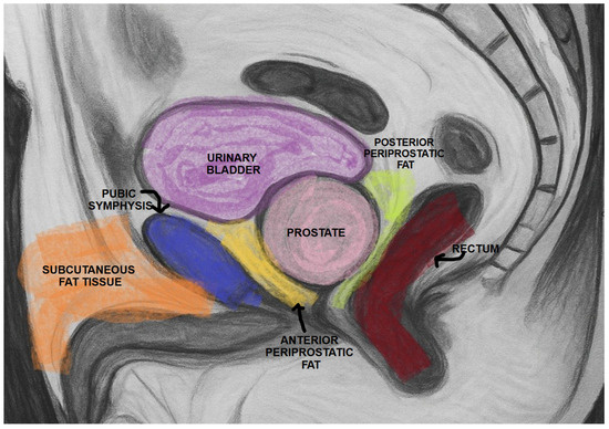 <p>the pubic symphysis</p><ul><li><p>lies directly anterior to the prostate</p></li></ul><p></p>
