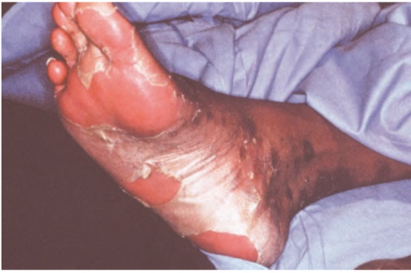 <p>Hint: Previously considered most severe form of erythema multiforme</p>