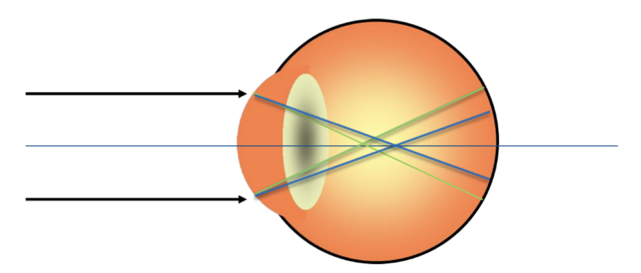 What type of astigmatism is this?