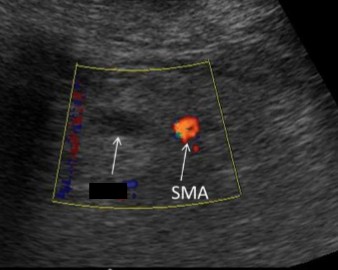<p>What is the name of the vessel crossed out and to the right of the SMA?</p>