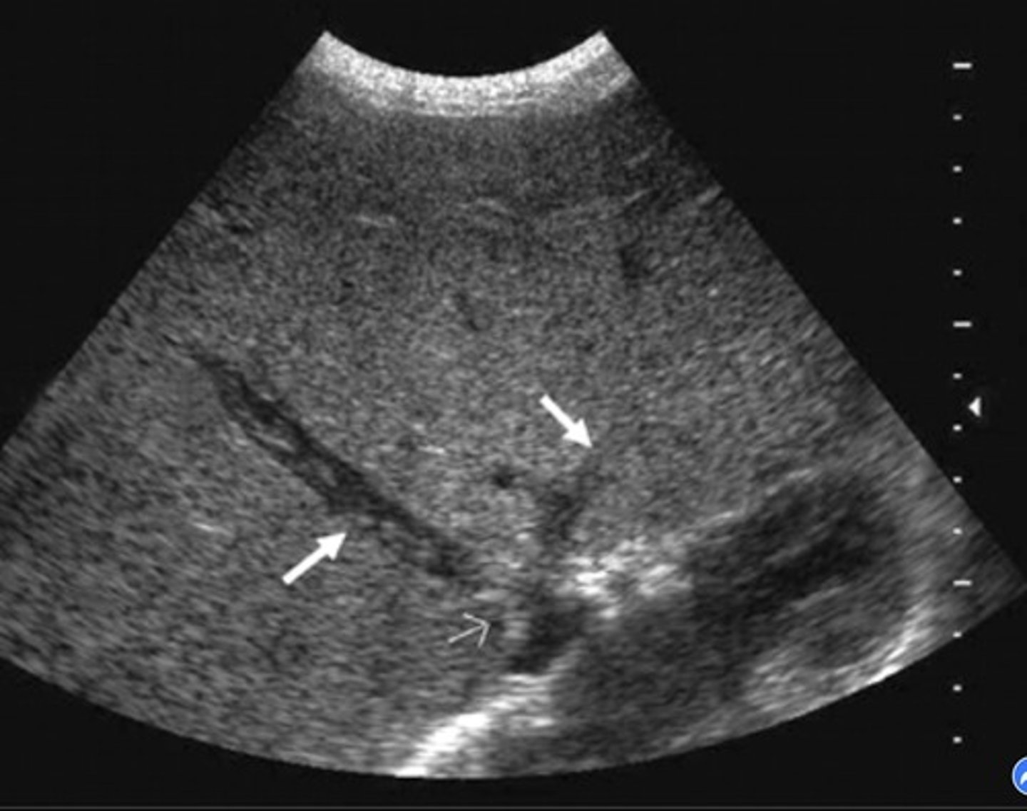 <p>Hepatic vein thrombosis/post-sinusoidal thrombosis</p><p>Monophasic, reduced/reversed flow in portal vein</p><p>Enlarged caudate lobe</p><p>Ascites</p><p>Splenomegaly</p>