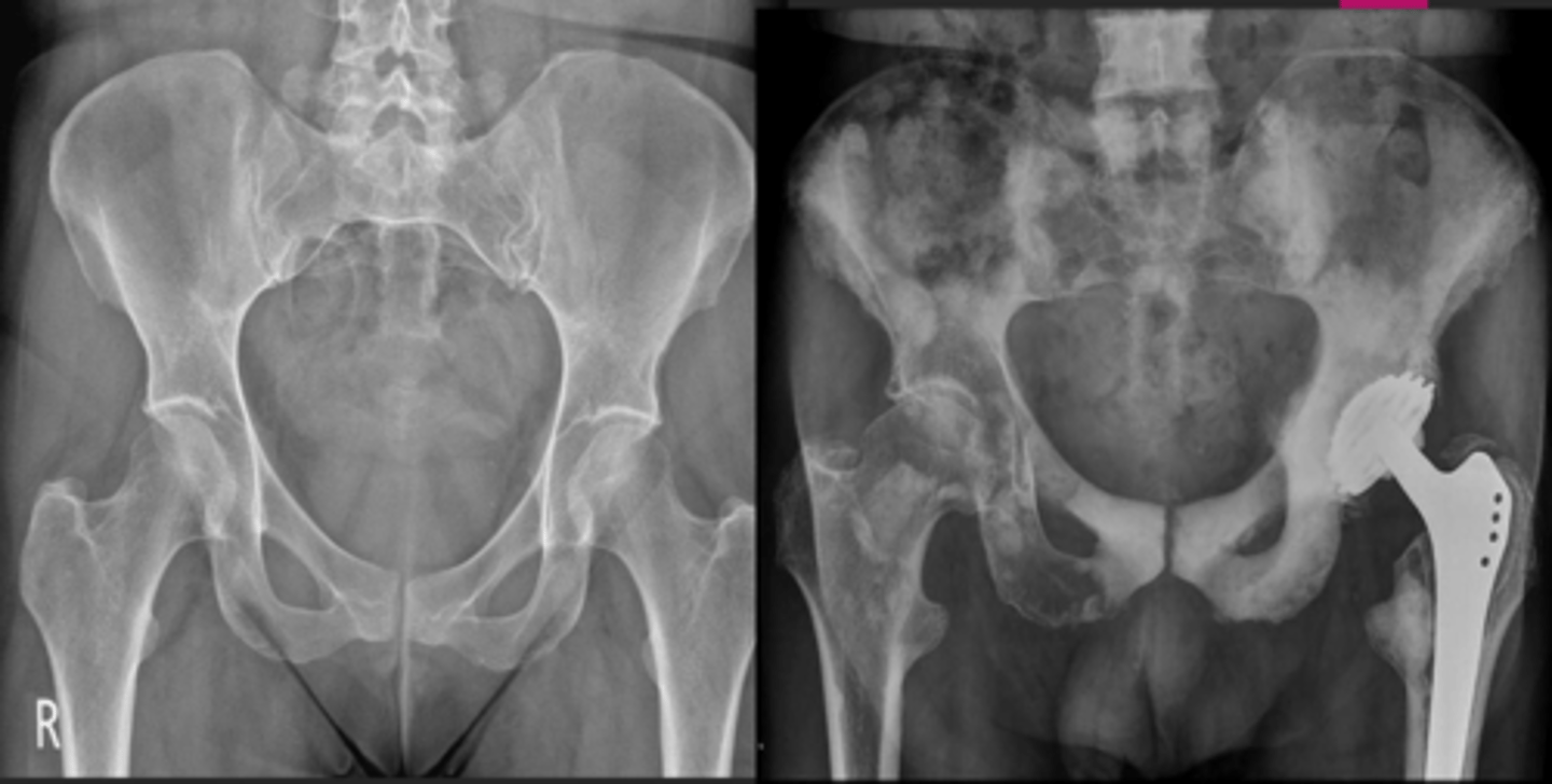 <p>Image on the left is normal, is the image on the right diffuse or local?</p>
