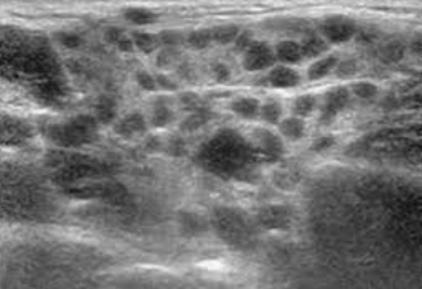 <p>Etiology</p><p>-Chronic autoimmune disease</p><p>Clinical findings</p><p>-Eye and mouth dryness</p><p>-Severe dental caries</p><p>-Frothy saliva</p><p>Sonographic findings</p><p>-Inhomogeneous gland with small, oval hypoechoic or anechoic areas</p><p>-May demonstrate hypervascularity </p>