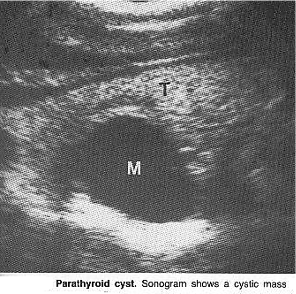 <p>Sonographically CANNOT be differentiated from other cystic neck masses</p>