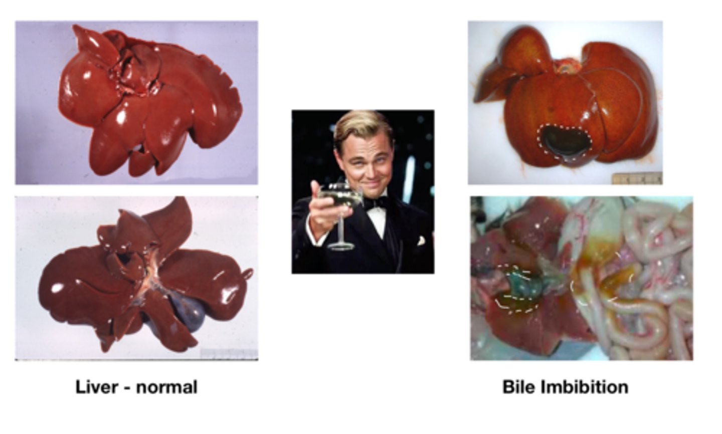 <p>- Dark green staining of tissues due to breakdown of gallbladder and release of bile, usually affects tissues directly surrounding the gall bladder</p>