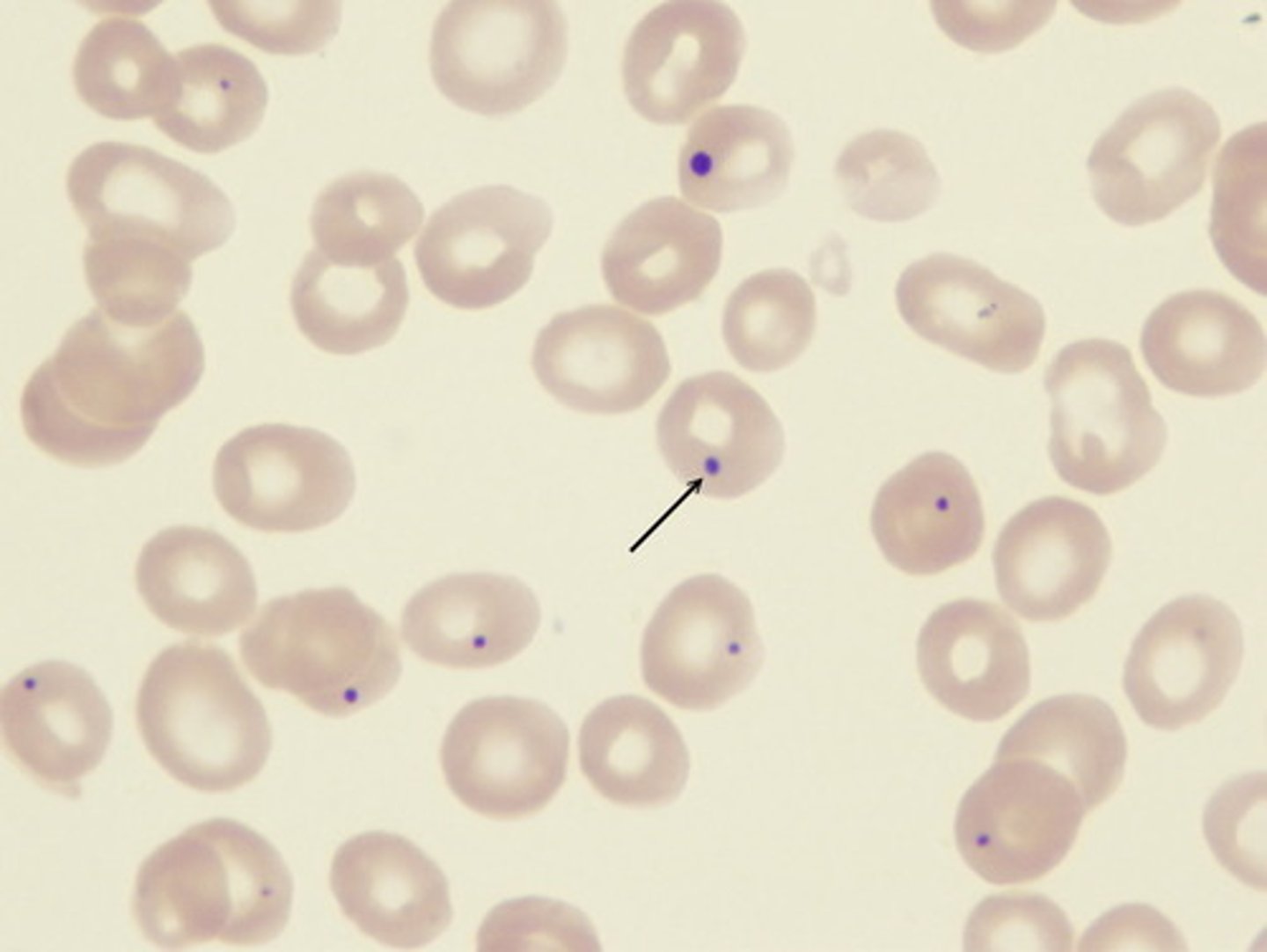 <p>remnants of chromatin, severe anemias or aspleenia</p>