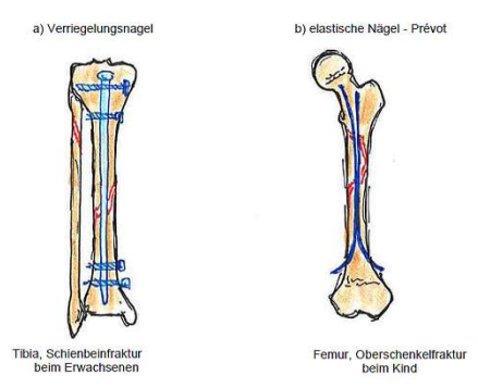 <p>Operative Frakturbehandlung</p><p><strong>Intramedulläre Schienung</strong></p><p><strong>a)</strong>&nbsp;Nagel im Hohlraum des Knochens - Knochen kann nicht verrutschen - Druck auf Fraktur</p><p><strong>b)</strong>&nbsp;Nägel lassen sich gegenseitig verspannen - sehr fest eingewachsen - schwer zu entfernen</p>