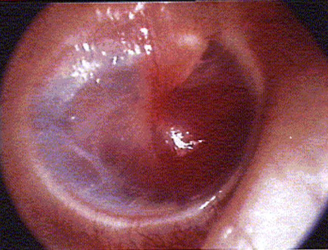 <p><u>disordered otoscopy: middle ear</u></p><p>glomus tumor</p>