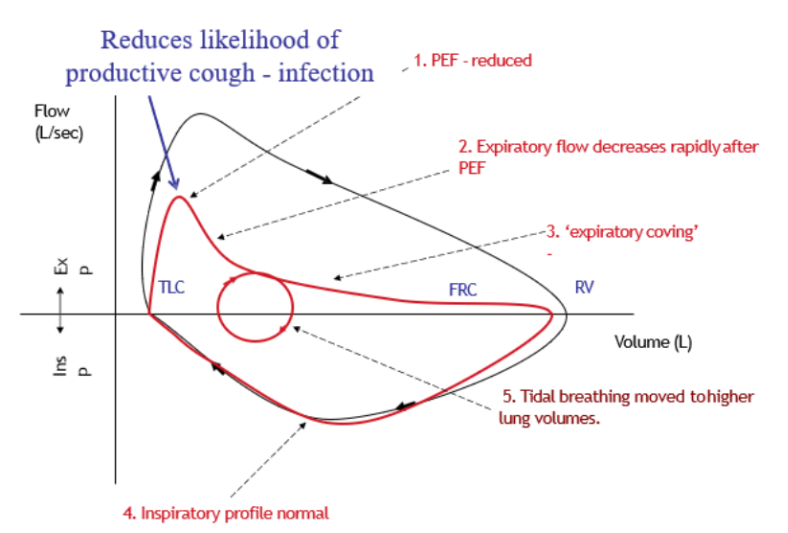<ul><li><p>Reduced PEF</p></li><li><p>Expiratory flow decreases rapidly after PEF</p></li><li><p>‘Expiratory Coving‘</p></li><li><p>Normal inspiratory profile</p></li><li><p>Tidal breathing moved to higher lung volume</p></li></ul>