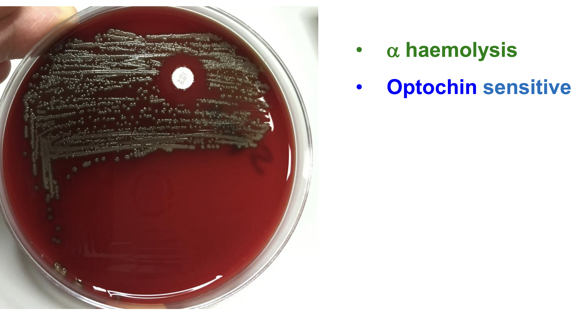 <p><strong><u>Description</u></strong></p><p>– <strong><mark data-color="purple" style="background-color: purple; color: inherit;">GP pneumococcus ovoid or lanceolate cocci in pairs</mark></strong> (diplococci)</p><img src="https://knowt-user-attachments.s3.amazonaws.com/64075840-4380-45aa-99d5-9aab2c1a15f8.png" data-width="50%" data-align="center"><p>– grow well on blood agar</p><p><strong><u>Colony morphology</u></strong></p><p><strong>• small (1mm), circular, raised, smooth</strong></p><p><strong>• </strong><span style="color: green;"><strong>α-haemolysis</strong></span></p><p><strong>– Optochin sensitive</strong></p>