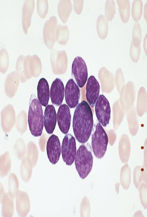 <p>What type of leukemia is this? Acute or Chronic</p>