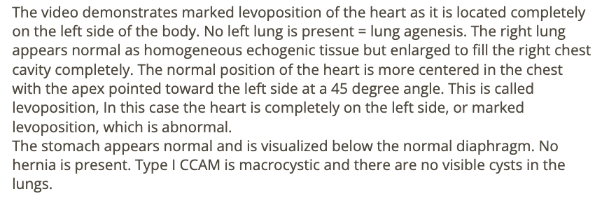 <p>d) left lung agenesis</p>