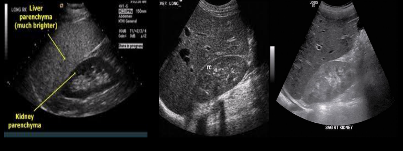 <p>Which kidney has an abnormal echogenicity? </p>