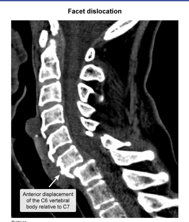 <p>Facet Dislocation</p>