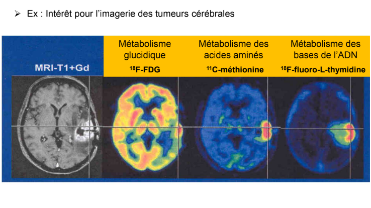 <p>Par exemple, si on veut faire de l’imagerie de tumeur cérébrale, comme de base, le cerveau consomme beaucoup de glucose, si on veut voir quelque chose qui consomme du glucose dans un organe qui consomme beaucoup de glucose, il va y avoir un <strong>problème de contraste</strong>. Donc on peut utiliser des vecteurs spécifiques d’autres voies métaboliques :</p><ul><li><p><strong>Métabolisme des acides aminés</strong> : analogues de la méthionine → <strong><sup>11</sup>C-méthionine </strong>→ on voit beaucoup mieux le site tumoral qu’avec juste du FDG car de base, le cerveau ne capte pas trop ces acides aminés</p></li><li><p><strong>Métabolisme des bases de l’ADN : <sup>18</sup>F-fluoro-L-thymidine</strong>. C’est un médicament qui rentre assez mal dans le cerveau. Donc si on a un gliome qui entraîne une rupture de la barrière hémato-encéphalique par exemple, il va y avoir une pénétration locale du médicament très définie →affine le diagnostic</p></li></ul><p></p>