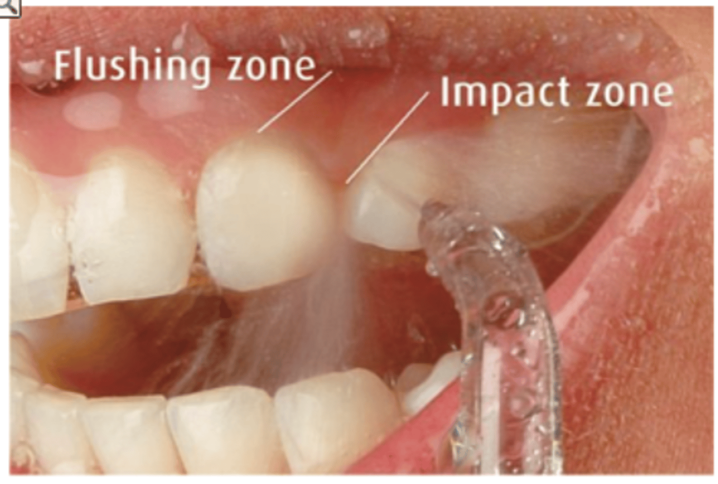 <p>compression and decompression of tissue resulting in displaced biofilm</p>