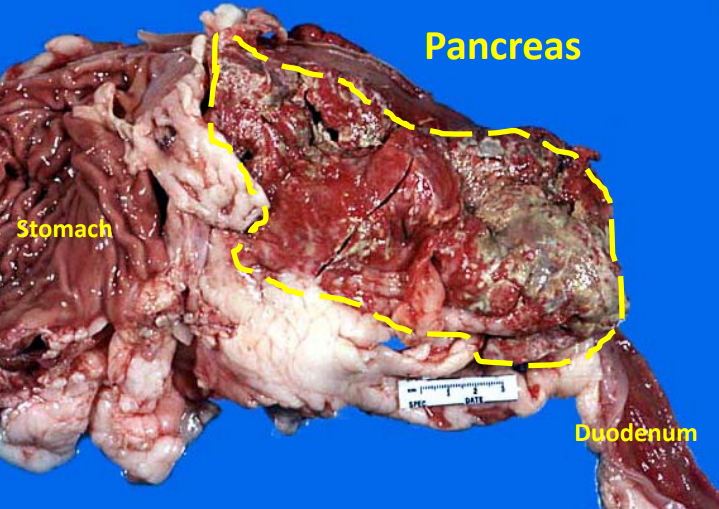 <p>Pancreas from a dog. Clinical history of having a high-fat meal 3 days ago (ate pork scraps). Presented with anorexia, vomiting, depression, and a fever. Abdominal ultrasound revealed a lack of detail in the cranial abdomen (edema and/or local peritonitis); no mass is observed. Morphological diagnosis?</p>
