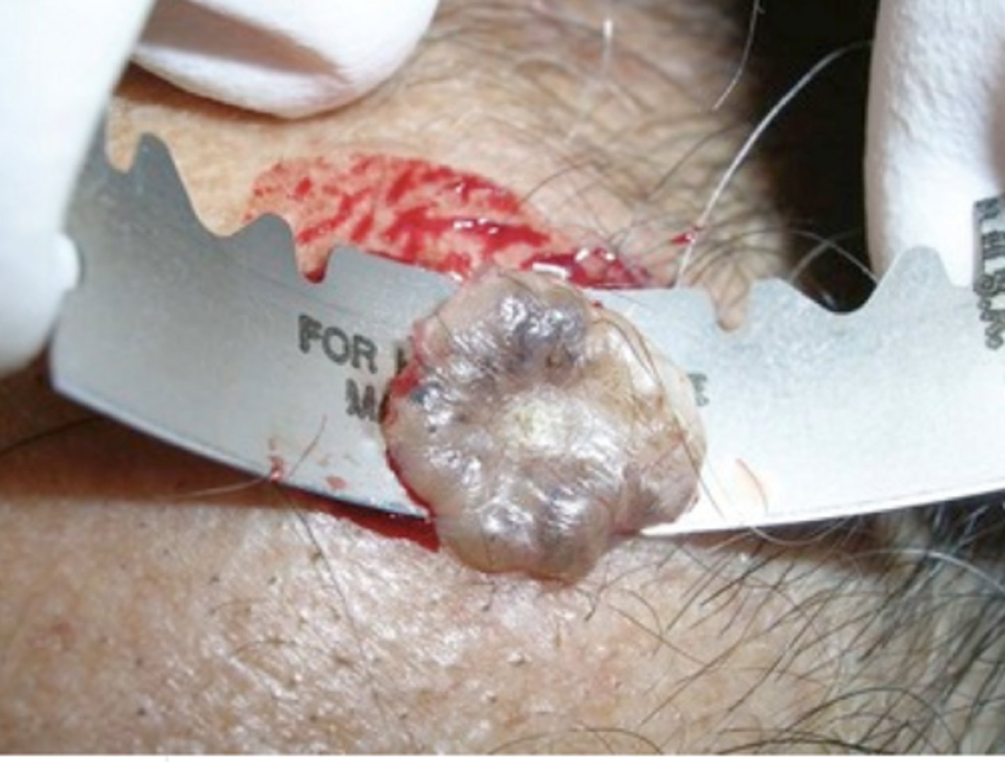 <p>Shave biopsy</p>